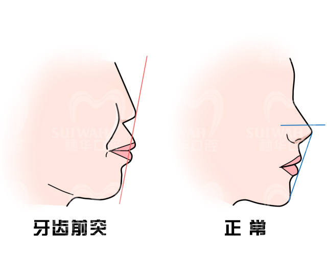 因为决定人脸宽窄,方尖是我们的下颌骨.