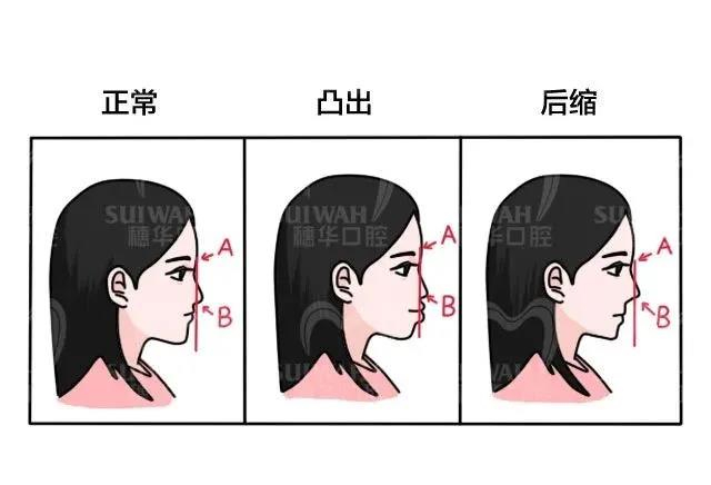 开唇露齿,拔牙的可能性就大,如果是直面型或者凹面型而且唇齿关系正常