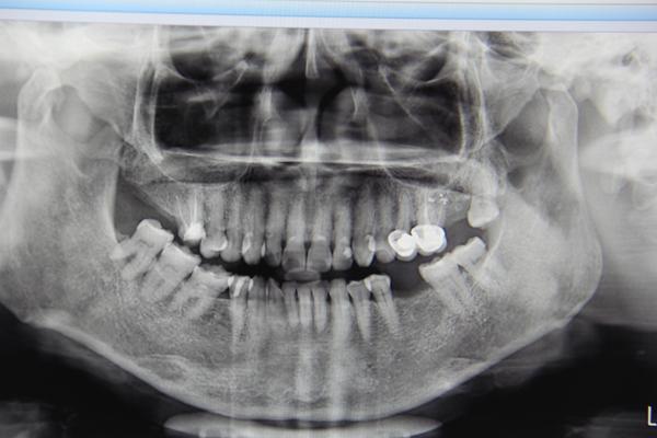 3d靶向种植牙直播手术在穗华口腔医院圆满落幕