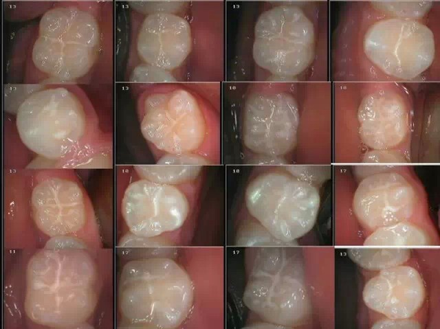 做窝沟封闭有副作用吗
