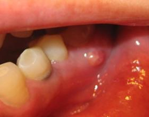 牙龈癌图片 征兆图片