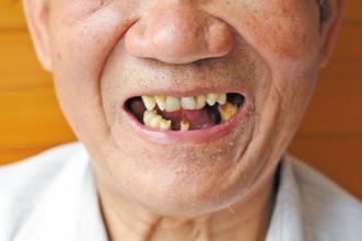 世界上牙齿最多的人图片